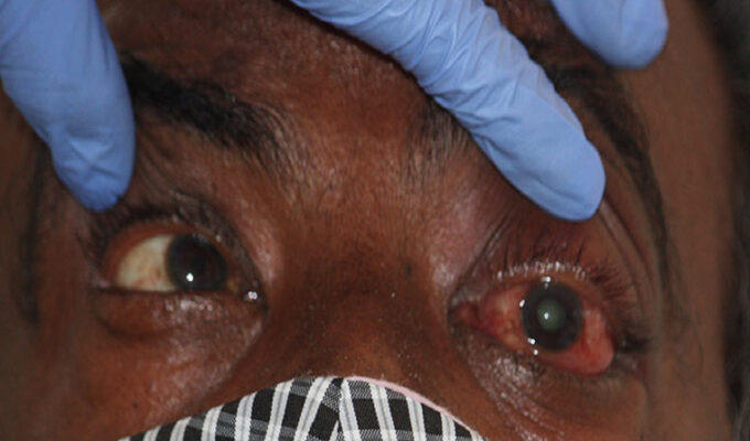 Corona-Black-Fungus-Patient